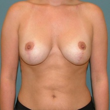 Breast Surgery After