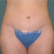 Body Contouring After
