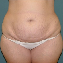 Body Contouring Before