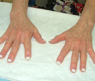 Fat Grafting Hands Before