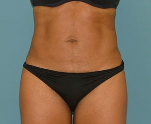 liposuction_after
