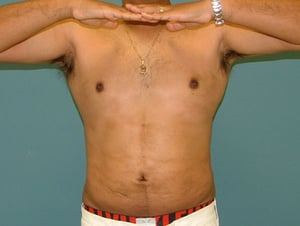 liposuction_after