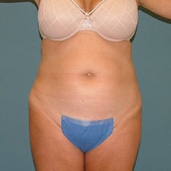 liposuction_before