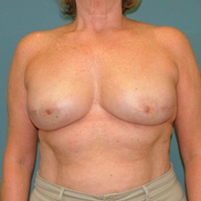 bilateral_mastectomy_after