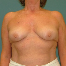 bilateral_mastectomy_before