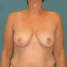 breast-reconstruction_female_front_after