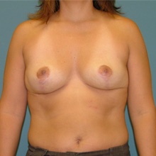 breast-reduction-front-after