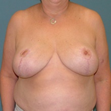 breast-reduction-front-after
