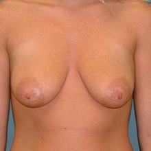Breast Surgery Before