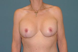 combination-body-lift+breast-lift_after