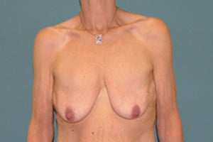 combination-body-lift+breast-lift_before