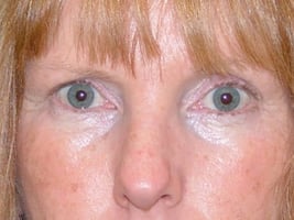 Blepharoplasty Eyelid Surgery Before