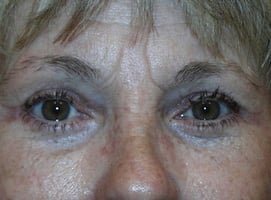 Blepharoplasty Eyelid Surgery After