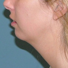 Cheek Contouring (Genioplasty) Before