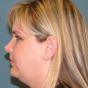 neck liposuction side before