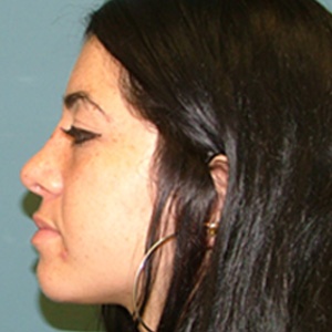 rhinoplasty_female_side view_after