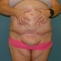 TUMMY TUCK 001_before front lifted