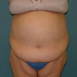 TUMMY TUCK 001_before front