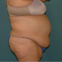 TUMMY TUCK 001_before right side